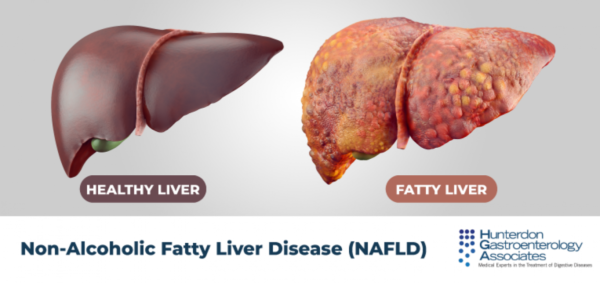 Fatty Liver? Weight Loss Tips To Help You Succeed